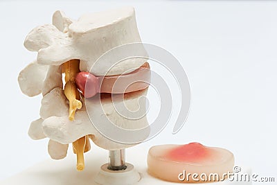 Artificial human herniated lumbar disc on white background Stock Photo