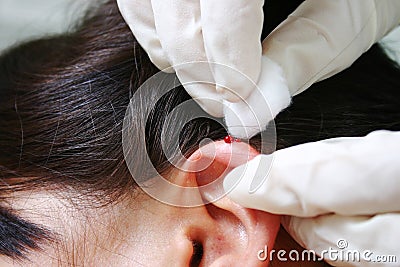 Ear needling Stock Photo