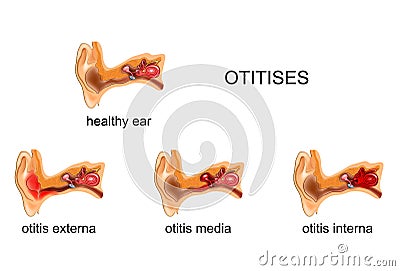 Ear. otitis media, internal, external, Vector Illustration