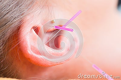 Ear of woman with acupuncture needles Stock Photo