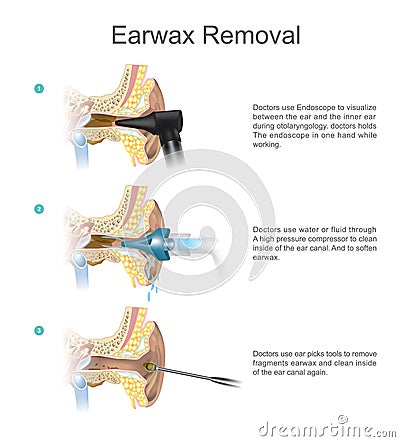 Earwax Removal. EARWAX s a common problem which is easily treated. Stock Photo