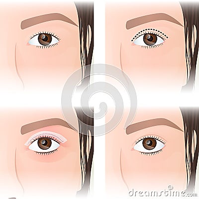 East Asian blepharoplasty, before and after images Vector Illustration