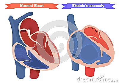 Ebstein anomaly versus normal heart structure vector illustration Vector Illustration