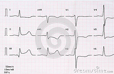 ECG with acute period of large-focal posterior diaphragmatic myocardial infarction Stock Photo