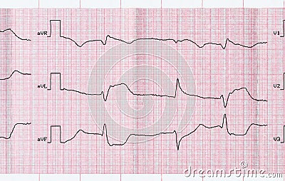 ECG with acute period macrofocal myocardial infarction and vent Stock Photo