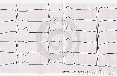 ECG with acute period of macrofocal posterior myocardial infarct Stock Photo