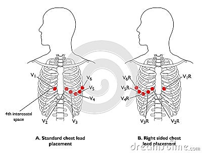ECG Chest Leads Royalty Free Stock Image - Image: 12861426