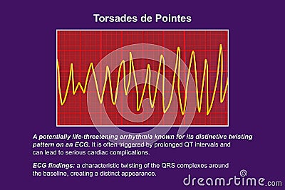 ECG displaying Torsades de pointes rhythm, 3D illustration Cartoon Illustration