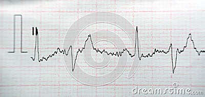 ECG ElectroCardioGraph paper that shows Normal Sinus Rhythm NSR with frequent PACs Premature Atrial Contractions, PVCs Premature Stock Photo