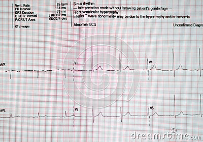 ECG ElectroCardioGraph paper that shows sinus rhythm abnormality of right ventricular hypertrophy, inferior T wave due to Stock Photo