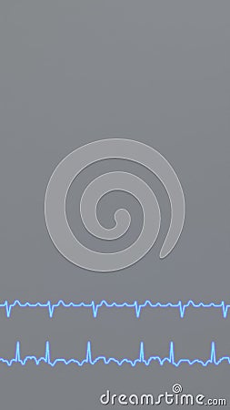 ECG graphs of regular and irregular atrial flutter Stock Photo