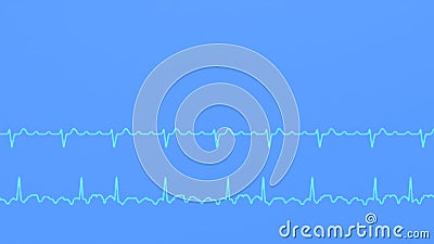 ECG graphs of regular and irregular atrial flutter Stock Photo