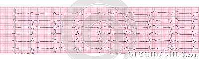 ECG with rhythm of artificial pacemaker ventricular pacing Stock Photo