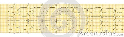 ECG with rhythm of artificial pacemaker ventricular stimulation Stock Photo