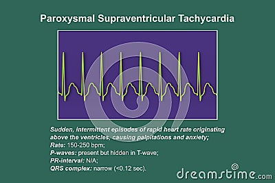 ECG in supraventricular tachycardia, 3D illustration Cartoon Illustration