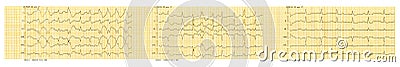 ECG tape with paroxysm of atrial fibrillation and restoration of sinus rhythm Stock Photo