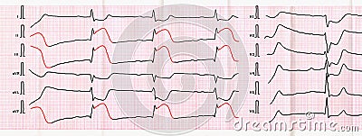 ECG tape with sharpest period of macrofocal posterior diaphragmatic myocardial infarction Stock Photo