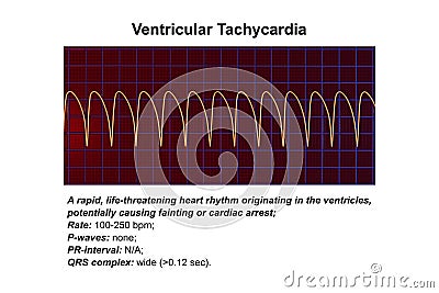 ECG in ventricular tachycardia, 3D illustration. Cartoon Illustration