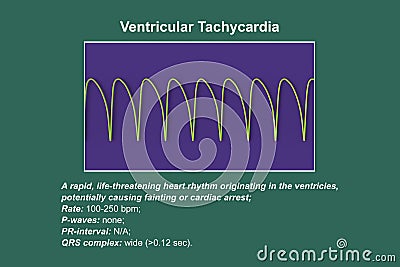 ECG in ventricular tachycardia, 3D illustration. Cartoon Illustration