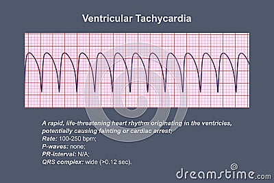 ECG in ventricular tachycardia, 3D illustration. Cartoon Illustration