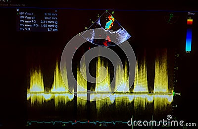 Echocardiogram colorful probe targeting map and waveforms Stock Photo