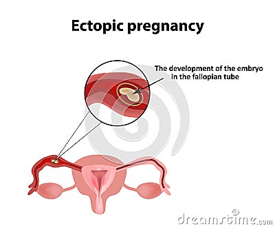 Ectopic pregnancy. The embryo in the fallopian tube. Infographics. Vector illustration on background Vector Illustration