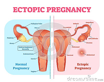 Ectopic Pregnancy or Tubal pregnancy medical diagram with female reproductive system and various embryo attachment locations. Vector Illustration