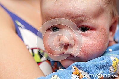 Eczema on face of newborn Stock Photo