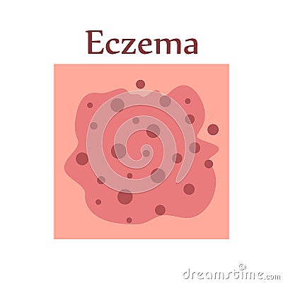 Eczema on human skin with itching, pain and rash Vector Illustration