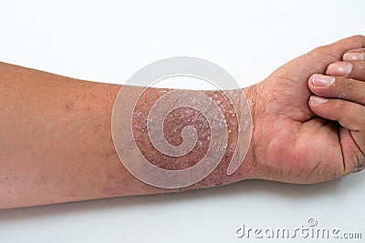 Eczema presents on the hand Stock Photo