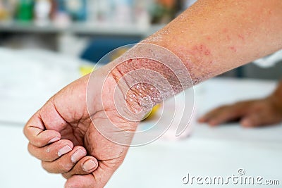 Eczema presents on the hand Stock Photo