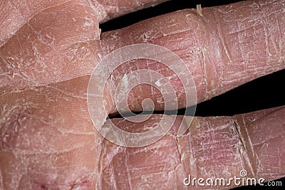 Eczema with redness, swellings, bumps and flakes on the hand and fingers Stock Photo