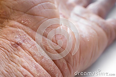 Eczema with redness, swellings, bumps and flakes on the hand and fingers Stock Photo