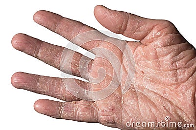 Eczema with redness, swellings, bumps and flakes on the hand and fingers Stock Photo