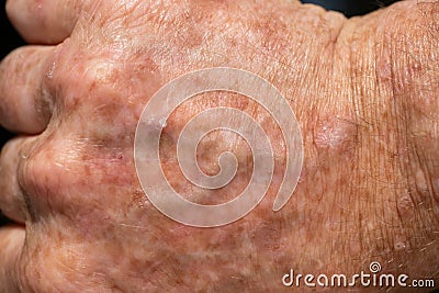 Eczema with redness, swellings, bumps and flakes on the hand of a man Stock Photo