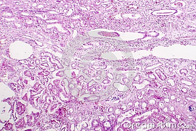 Edema of renal tubular epithelial cells in kidney failure Stock Photo