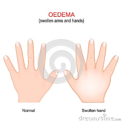 Edema. Swollen arms and hands. oedema Vector Illustration