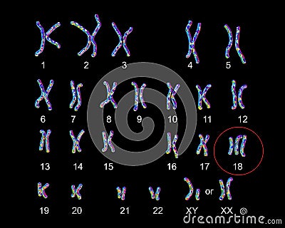 Edwards-syndrome karyotype Cartoon Illustration