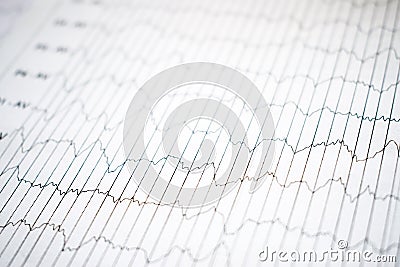 EEG electrophysiological monitoring method. EEG wave in human br Stock Photo