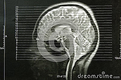 EEG x-ray skulls Stock Photo