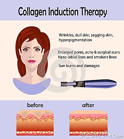 Before after effect, Microneedle stamping device, Collagen induction therapy Vector Illustration