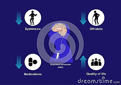 Concepts of deep brain stimulation for treatment of Parkinson`s disease Vector Illustration