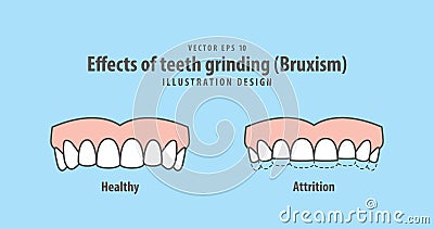 Effects of teeth grinding Bruxism illustration vector on blue Vector Illustration