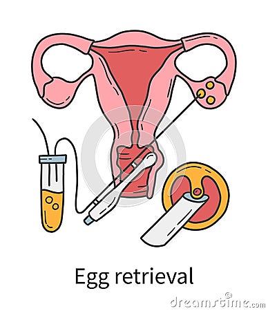 Egg retrieval and transvaginal oocyte extraction from ovaries, In Vitro fertilization Vector Illustration