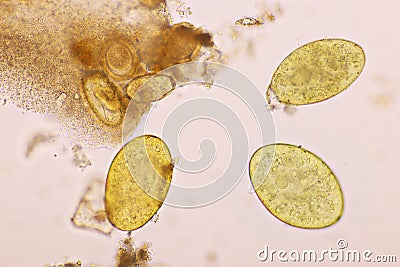 Eggs of intestinal fluke in human stool Stock Photo