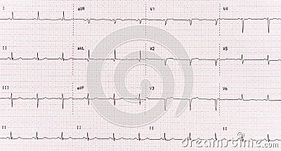 EKG Stock Photo