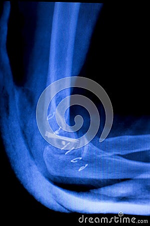 Elbow arm orthopedic implant xray scan Stock Photo