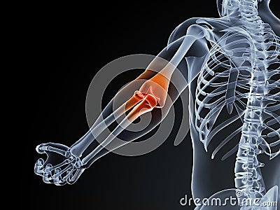 Elbow bursitis Cartoon Illustration