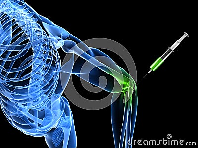 Elbow joint injection Cartoon Illustration