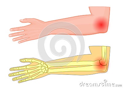 Elbow joint pain Vector Illustration